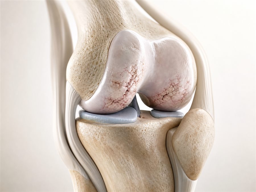 Medical visualization of osteoarthritis