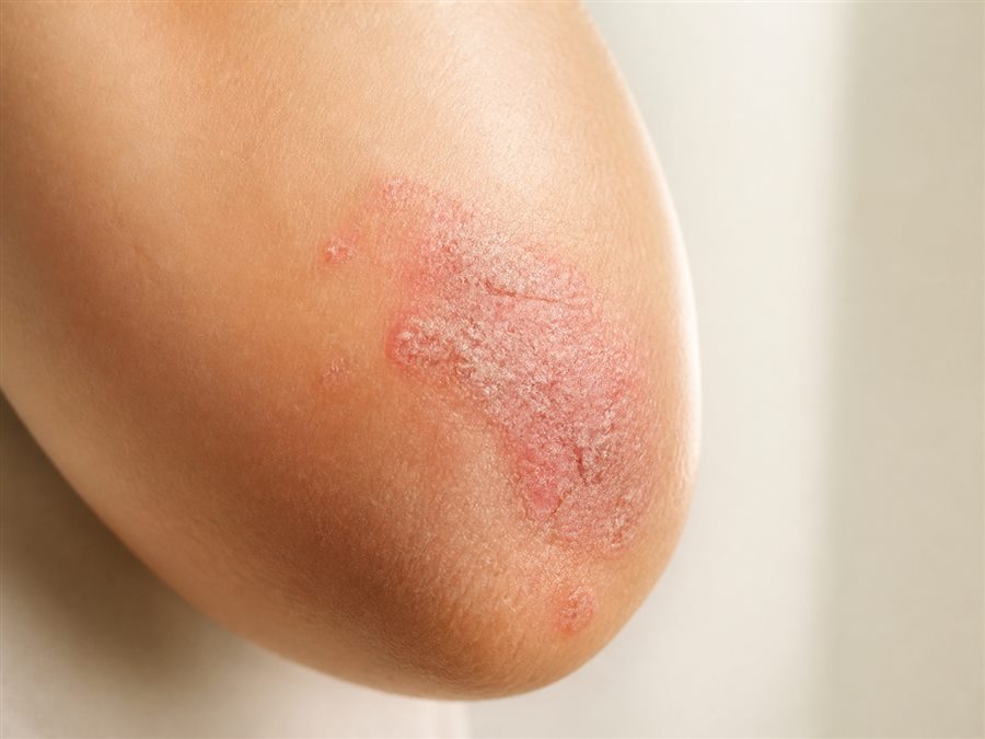 Medical visualization of psoriasis