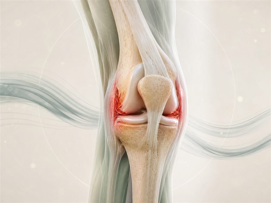 Medical visualization of rheumatoid arthritis