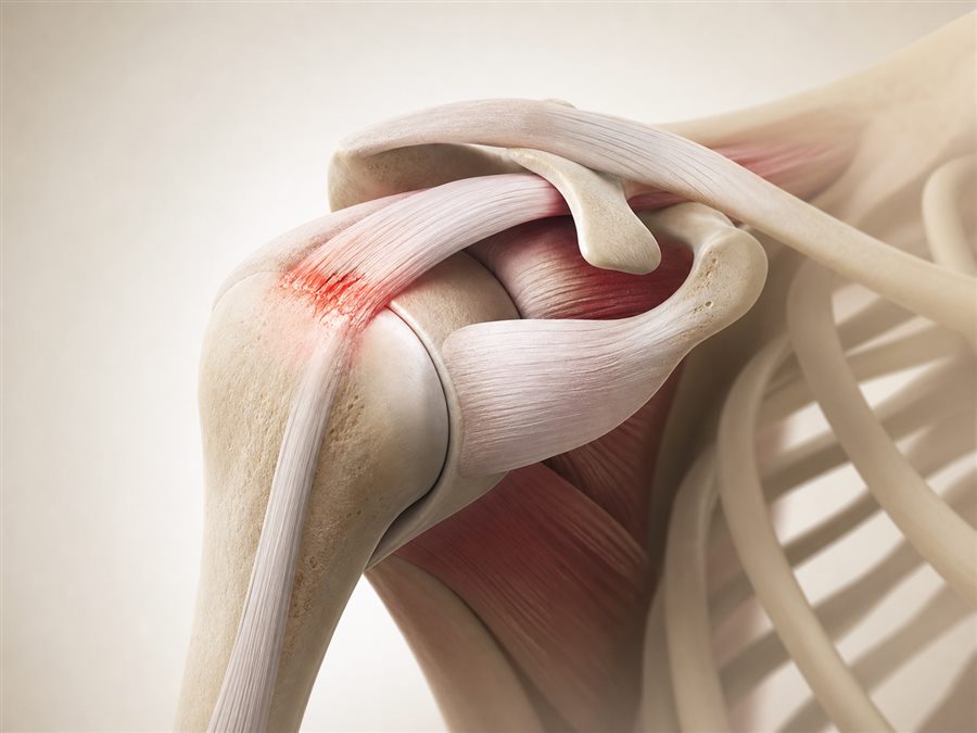Medical visualization of rotator cuff syndrome